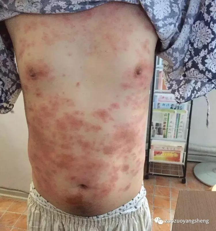案例分享：原始点调理5年慢性荨麻疹-原始点全球同学网