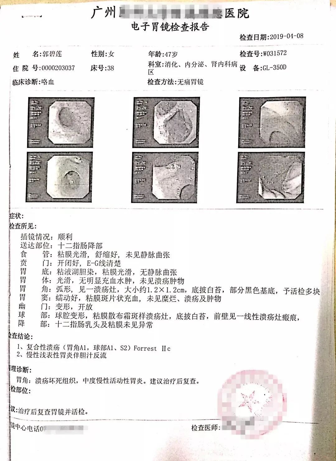 原始点调理肺炎咳血案例 原始点调理肺炎咳血案例
