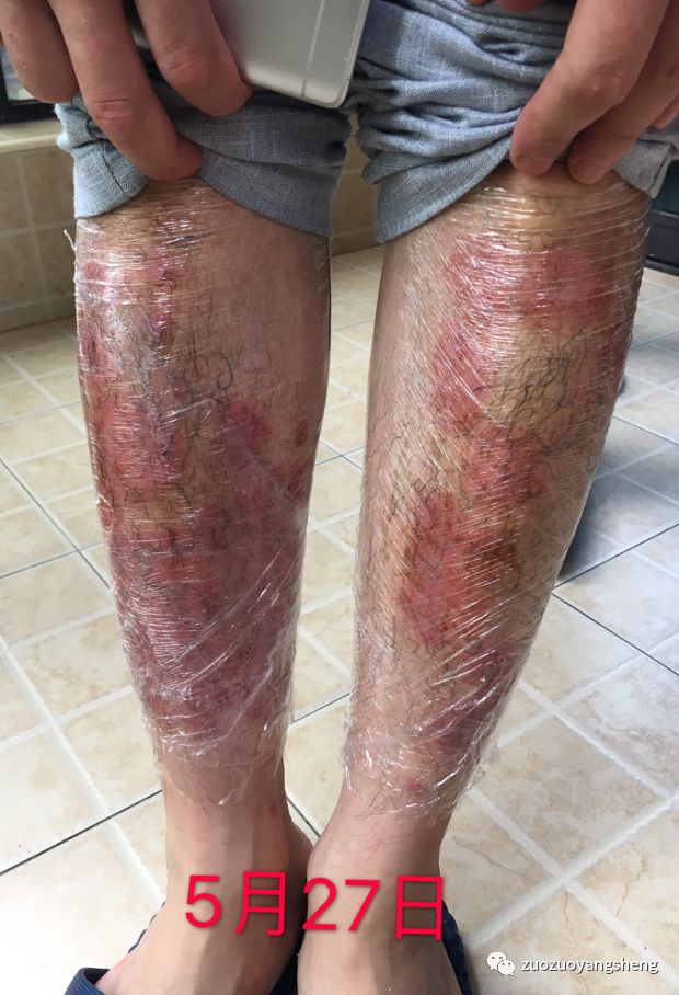 案例分享:原始点调理十几年牛皮癣的案例 案例分享:原始点调理十几年牛皮癣的案例