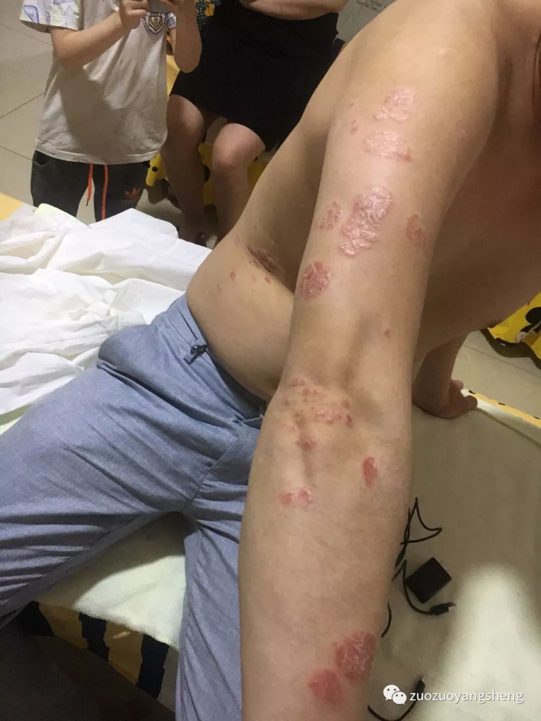 案例分享:原始点调理十几年牛皮癣的案例 案例分享:原始点调理十几年牛皮癣的案例