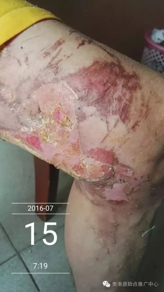 案例分享:原始点调理车祸烧伤不留疤的案例 案例分享:原始点调理车祸烧伤不留疤的案例