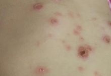 案例分享:原始点调理两岁儿童全身脓包溃烂流脓案例。-原始点全球同学网