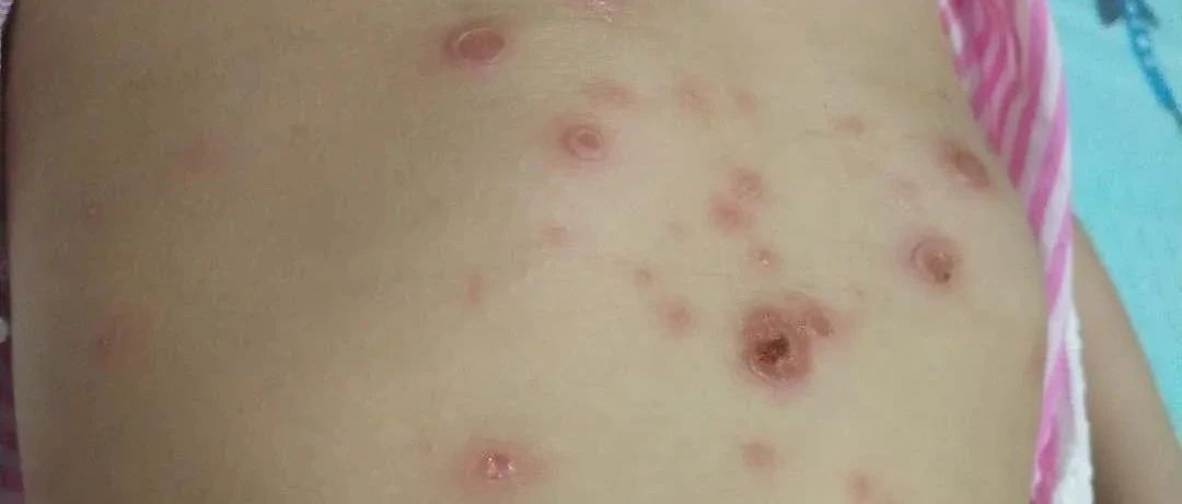 案例分享：原始点调理两岁儿童全身脓包溃烂流脓案例。-原始点全球同学网