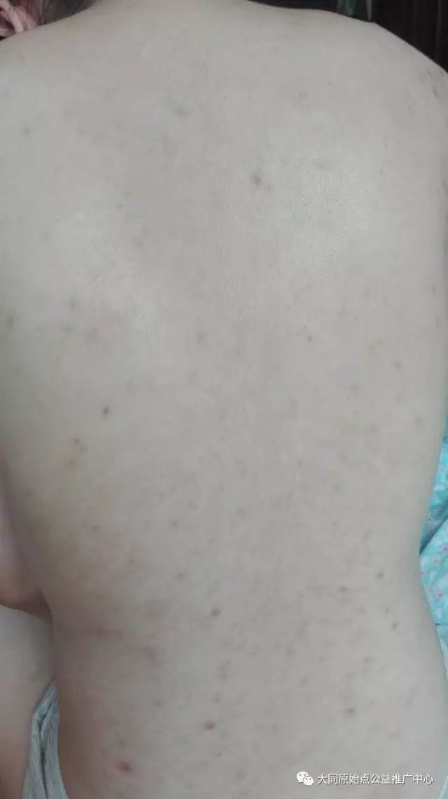 案例分享:原始点调理孕妇全身玫瑰藓的案例 案例分享:原始点调理孕妇全身玫瑰藓的案例