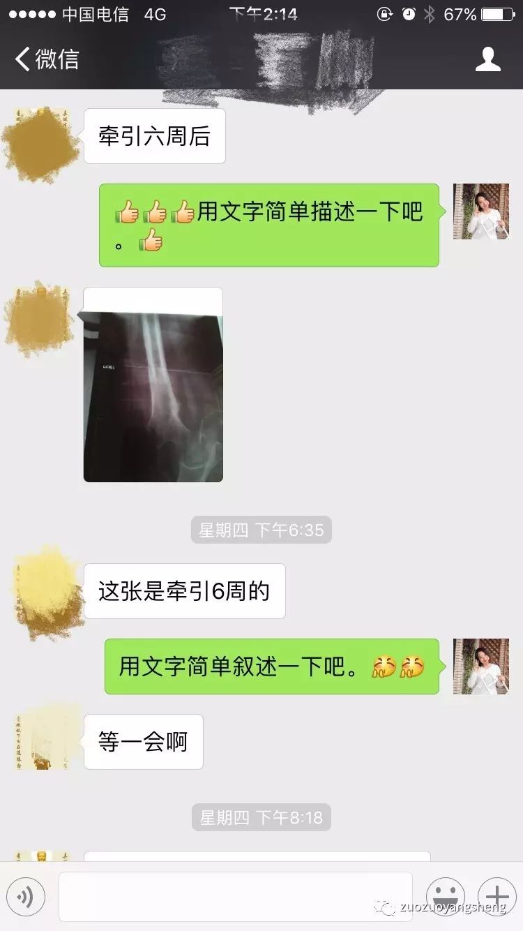 原始点续写又一奇迹:83岁婆婆骨折错位没开刀没手术,6周康复 原始点续写又一奇迹:83岁婆婆骨折错位没开刀没手术,6周康复