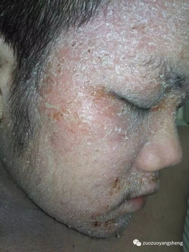 案例分享：马来西亚男孩严重湿疹，10天大变样-原始点全球同学网
