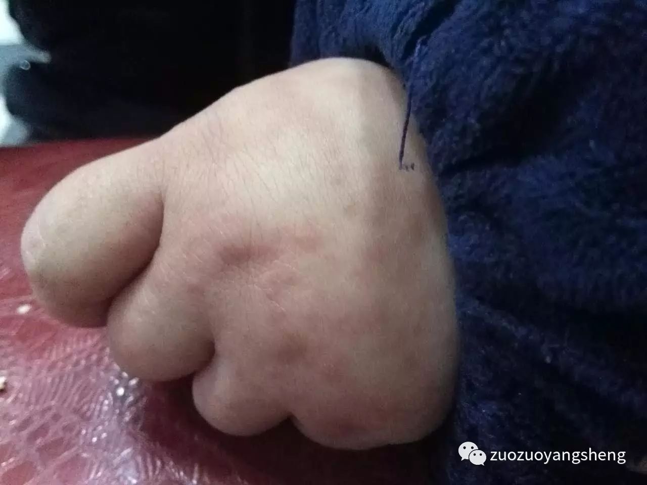 案例分享：原始点调理小朋友的婴幼儿急疹案例