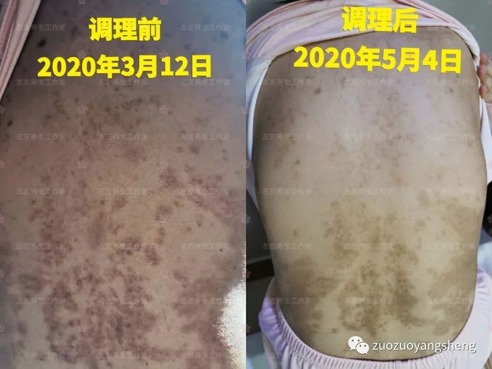 案例分享:原始点调理产后高血压,全身奇痒无比案例 案例分享:原始点调理产后高血压,全身奇痒无比案例