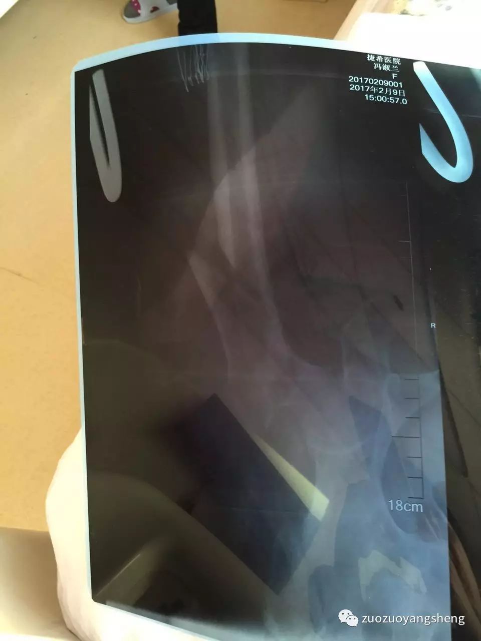 原始点续写又一奇迹：83岁婆婆骨折错位没开刀没手术，6周康复