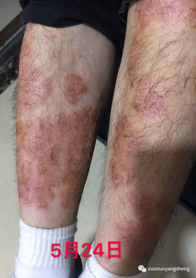 案例分享:原始点调理十几年牛皮癣的案例 案例分享:原始点调理十几年牛皮癣的案例