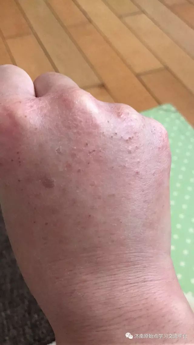 案例分享:巨痒湿疹案例 案例分享:巨痒湿疹案例