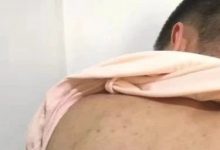 案例分析:原始点调理强制性脊柱炎的案例-原始点全球同学网