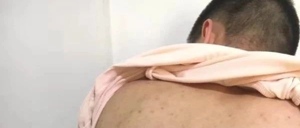案例分析：原始点调理强制性脊柱炎的案例-原始点全球同学网