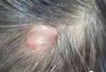 微问答143期：头部长了一个疮，里面是软的、有水，原始点要怎么处理？-原始点全球同学网