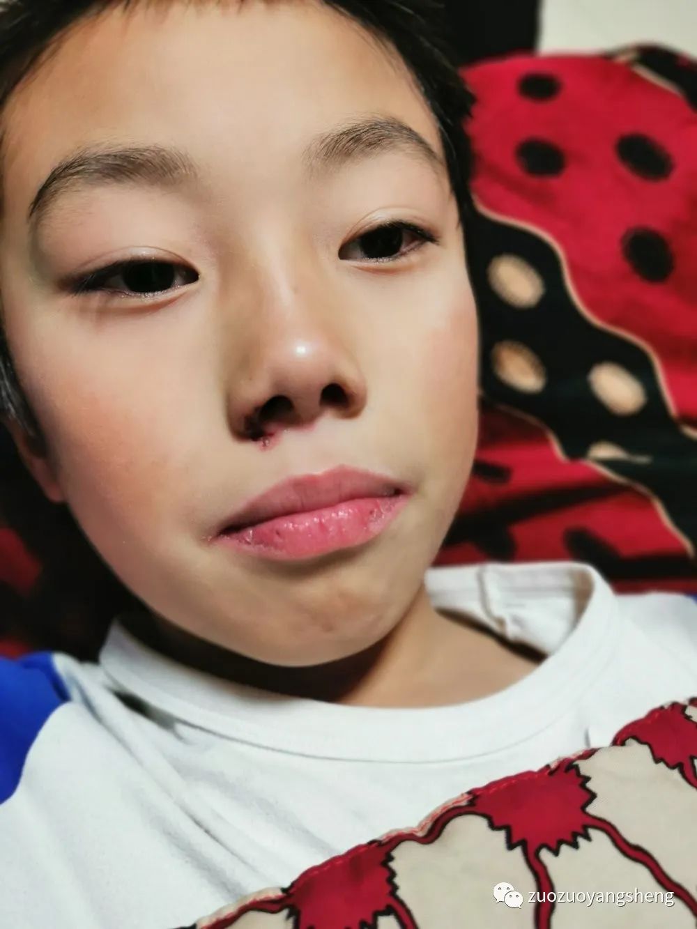 案例分享:原始点调理儿童淋巴结肿大,腺样体肥大,张嘴呼吸的案例 案例分享:原始点调理儿童淋巴结肿大,腺样体肥大,张嘴呼吸的案例