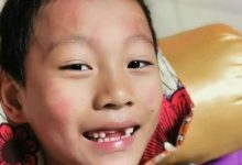 案例分享:原始点调理孩子需要做扁桃体切割手术的案例-原始点全球同学网