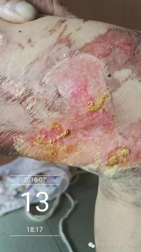 案例分享:原始点调理车祸烧伤不留疤的案例 案例分享:原始点调理车祸烧伤不留疤的案例