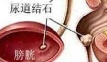 微问答195期：我弟弟尿尿是红色的，检查后医生怀疑是尿结石，该怎么办？-原始点全球同学网