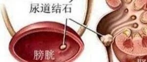 微问答195期：我弟弟尿尿是红色的，检查后医生怀疑是尿结石，该怎么办？-原始点全球同学网