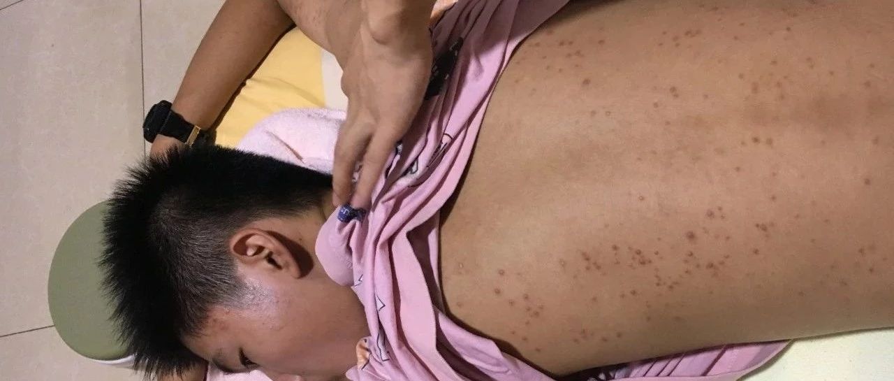 案例分享：原始点调理少年青春痘的案例-原始点全球同学网