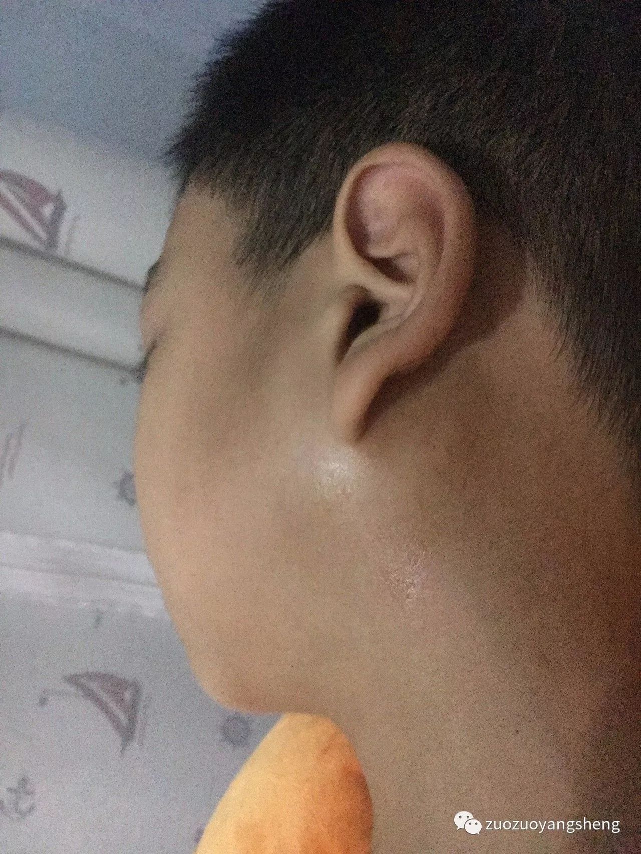 案例分享：原始点调理儿子的腮腺炎