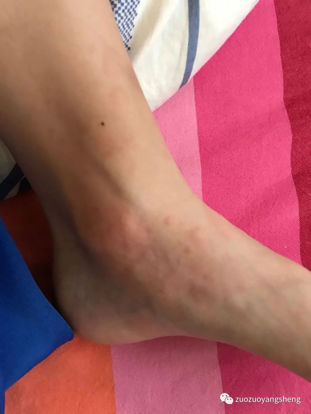 案例分享:原始点调理小孩疑似荨麻疹的案例 案例分享:原始点调理小孩疑似荨麻疹的案例