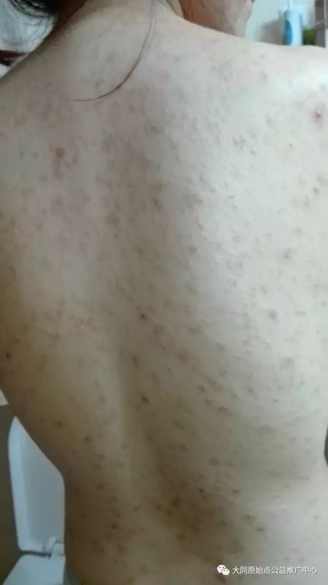 案例分享:原始点调理孕妇全身玫瑰藓的案例 案例分享:原始点调理孕妇全身玫瑰藓的案例