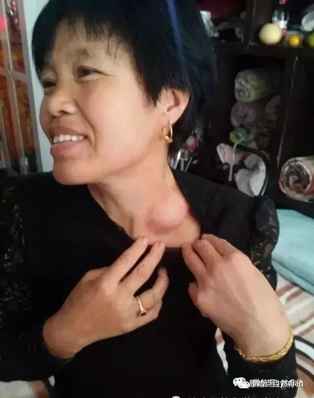 案例分享:原始点调理淋巴癌的案例 案例分享:原始点调理淋巴癌的案例