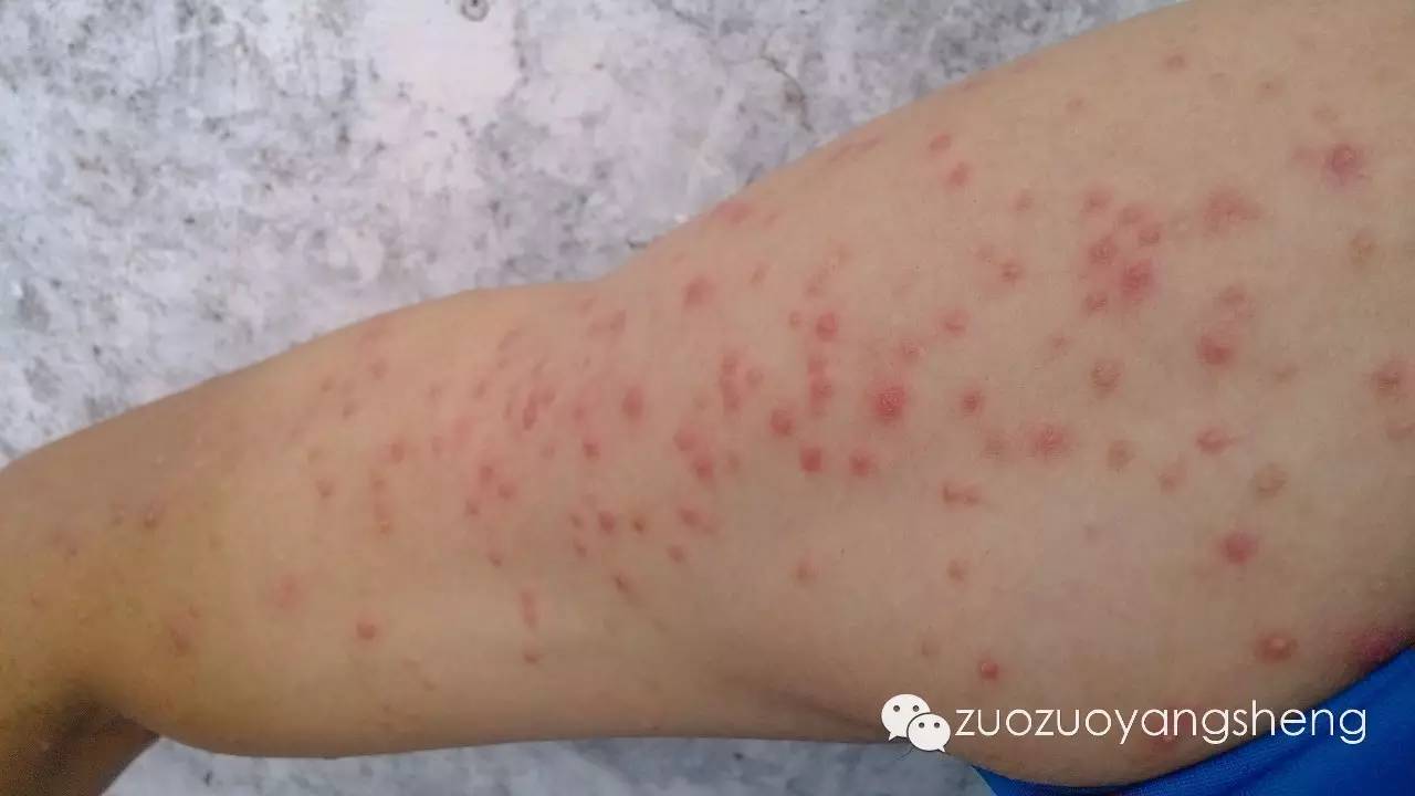 皮肤过敏，起疹子，用过很多软膏，效果不明显，容易反复，原始点可以调理吗？-原始点全球同学网