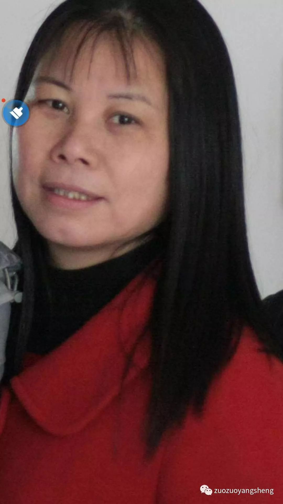 案例回访：三年前那位没去做心脏瓣膜置换术的谌女士现在情况怎么样了？