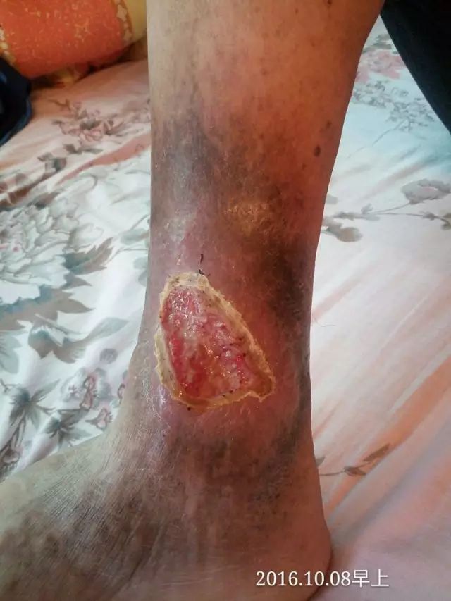 案例分享：原始点调理20年伤口不愈合的案例