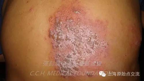 案例分享:原始点调理带状疱疹的案例 案例分享:原始点调理带状疱疹的案例
