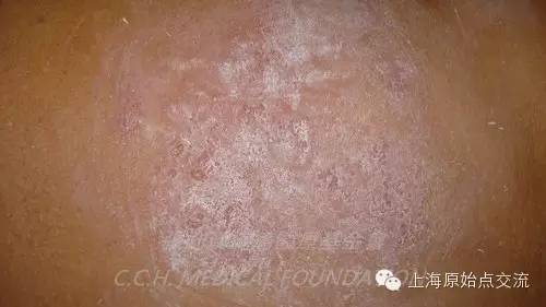 案例分享:原始点调理带状疱疹的案例 案例分享:原始点调理带状疱疹的案例