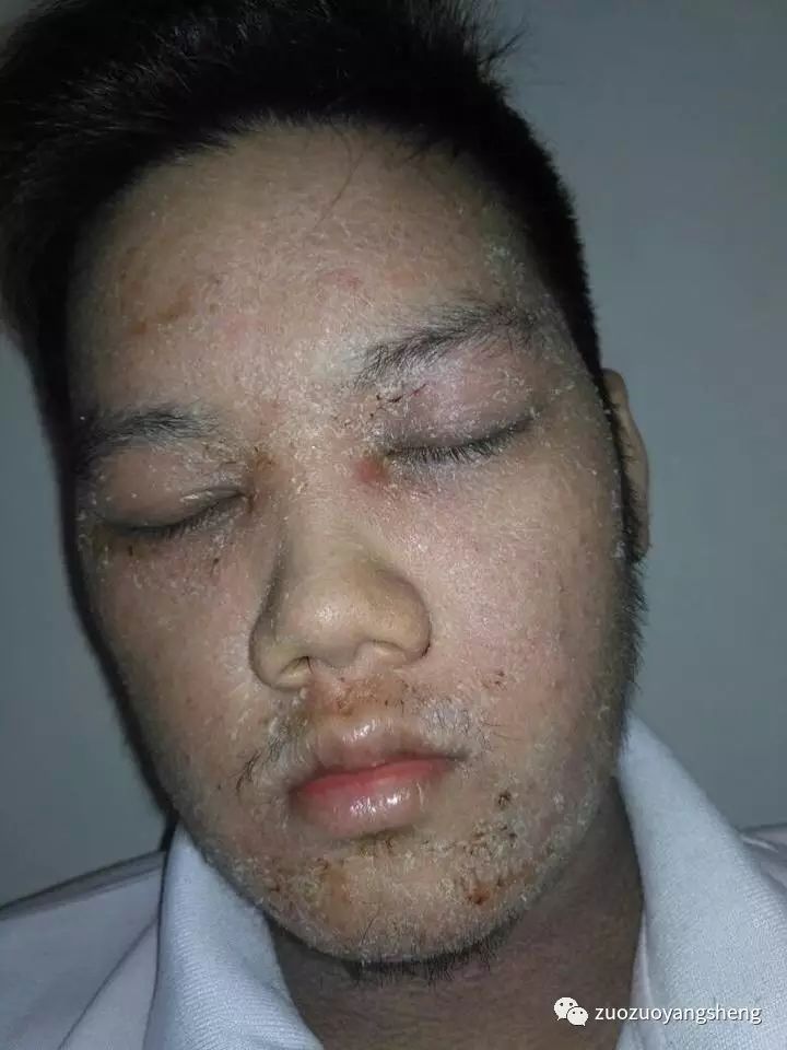 案例分享:马来西亚男孩严重湿疹,10天大变样 案例分享:马来西亚男孩严重湿疹,10天大变样