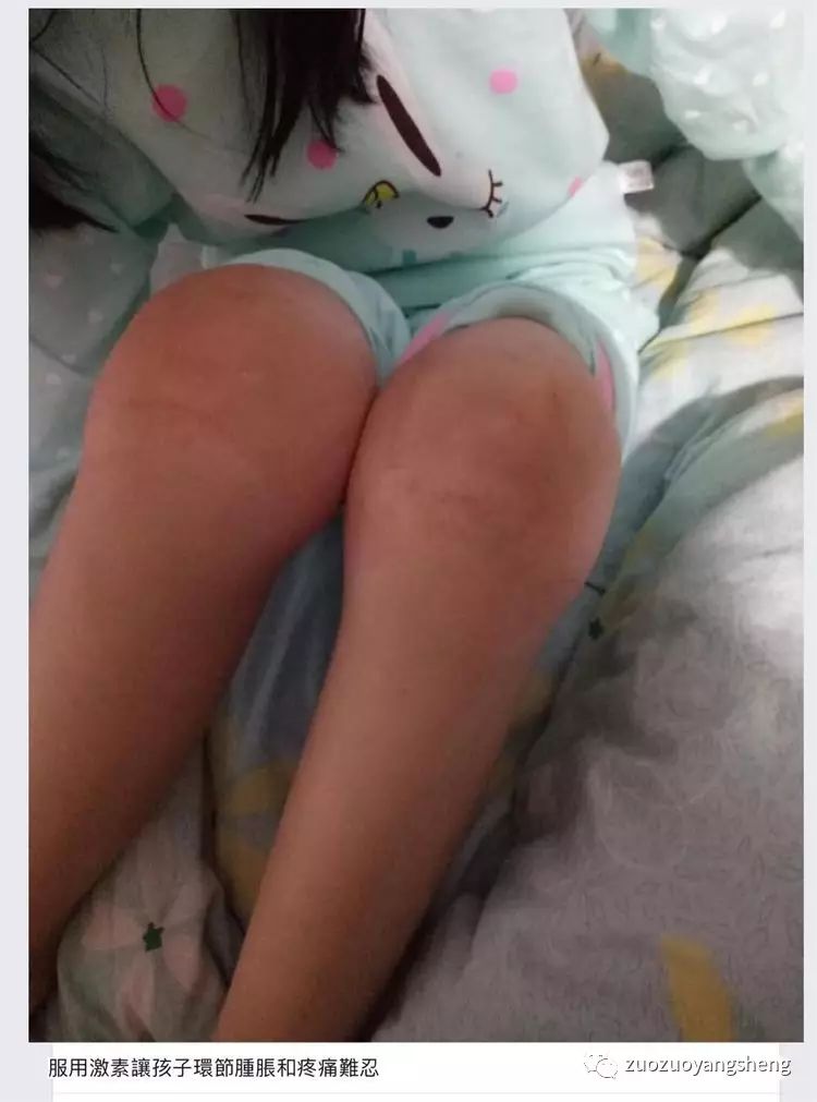 案例分享：原始点调理好服用激素和生物制剂5年的宝宝