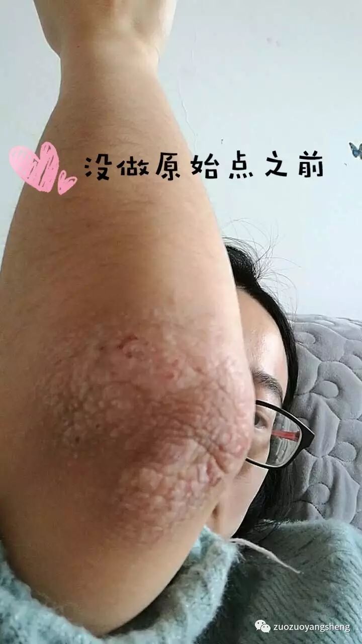 案例分享：原始点调理8年手肘湿疹案例