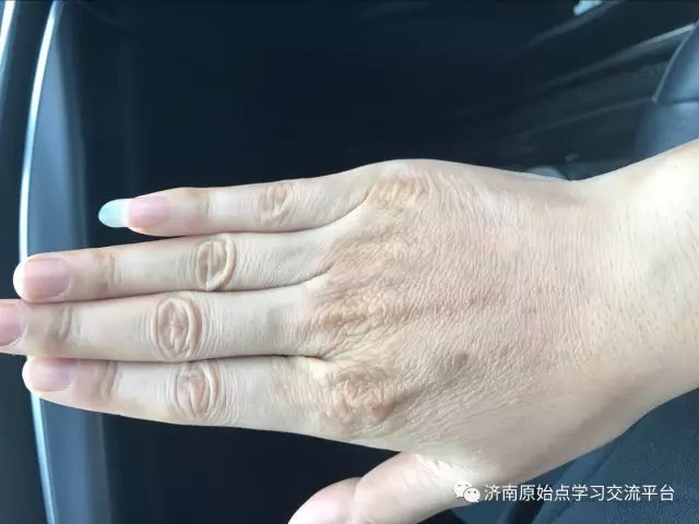 案例分享:巨痒湿疹案例 案例分享:巨痒湿疹案例