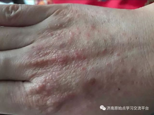 案例分享:巨痒湿疹案例 案例分享:巨痒湿疹案例