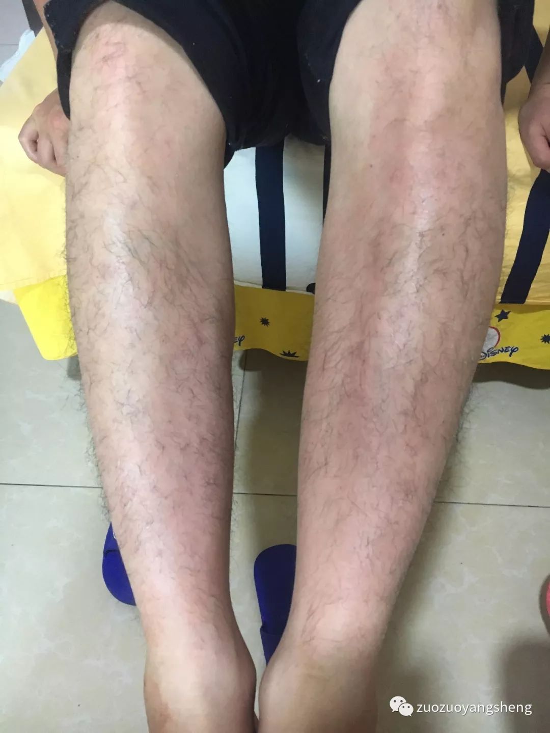 案例分享:原始点调理十几年牛皮癣的案例 案例分享:原始点调理十几年牛皮癣的案例