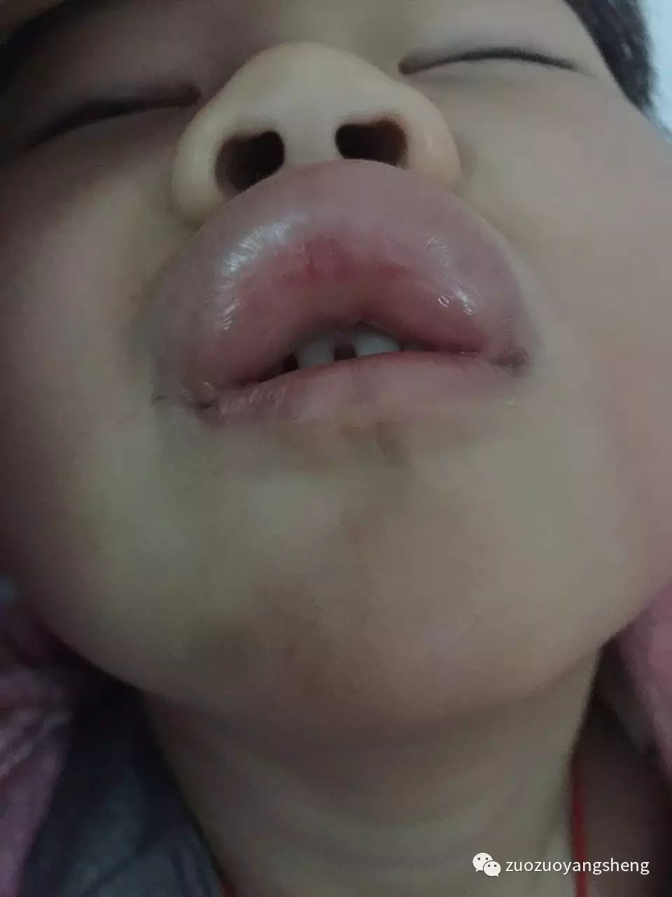 案例分享:原始点调理新年“食物中毒”的案例 案例分享:原始点调理新年“食物中毒”的案例