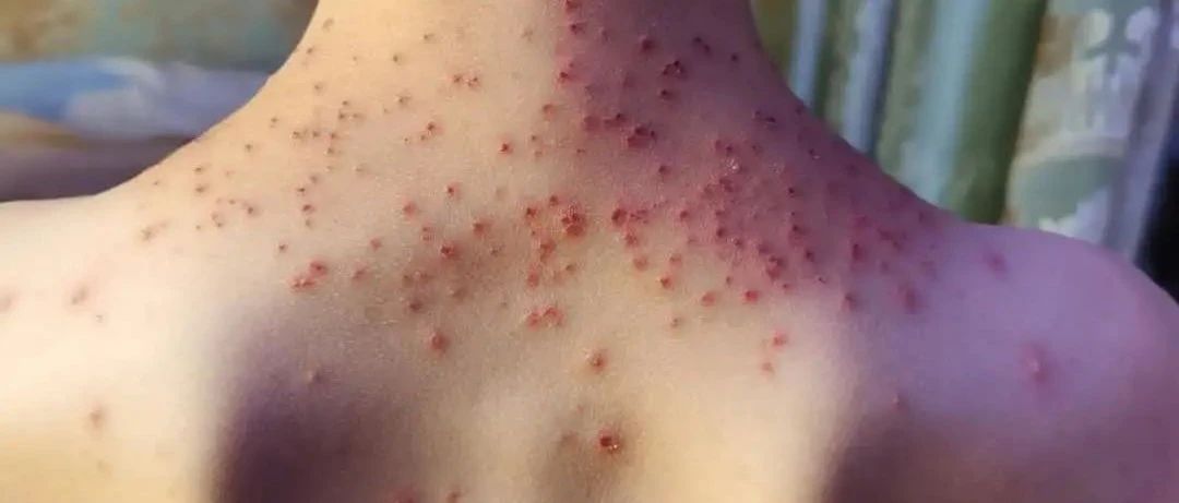 案例分享：原始点调理孩子水痘案例-原始点全球同学网