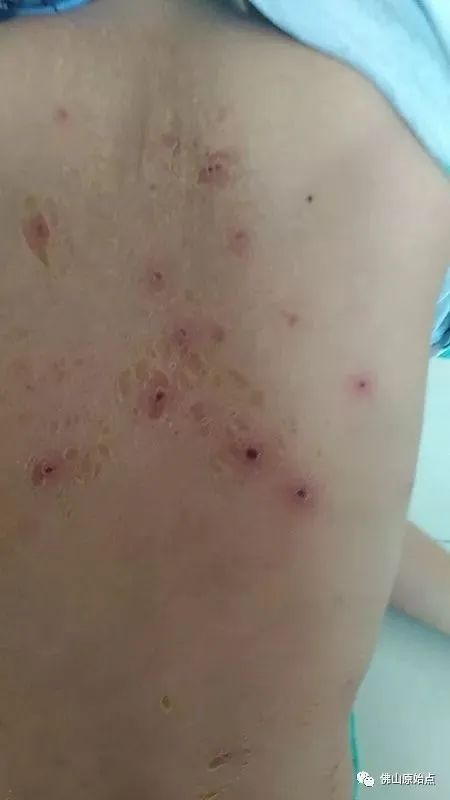 佛山原始点中心学员花开深圳:妈妈用原始点为七岁儿调理水痘9天康复案例 佛山原始点中心学员花开深圳:妈妈用原始点为七岁儿调理水痘9天康复案例
