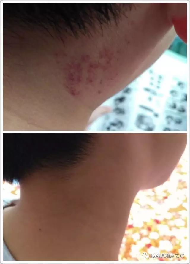 案例分享：原始点调理血小板减少症的案例