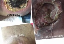 案例分享：原始点调理病危老人的案例-原始点全球同学网