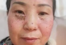 案例分享:原始点调理脸部严重过敏案例-原始点全球同学网