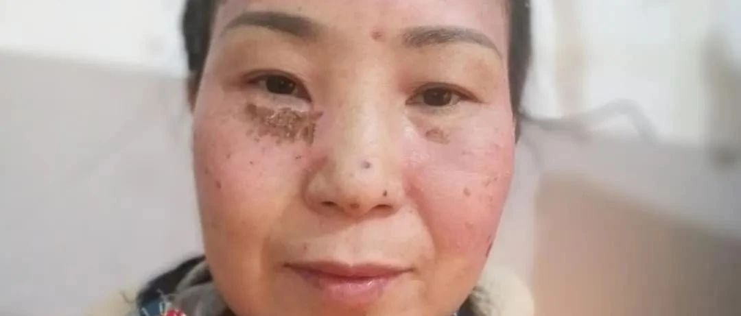 案例分享：原始点调理脸部严重过敏案例-原始点全球同学网
