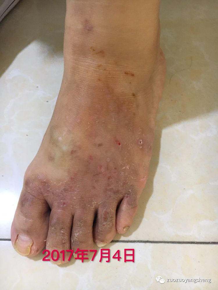 案例分享:原始点调理全身奇痒无比的湿疹案例 案例分享:原始点调理全身奇痒无比的湿疹案例