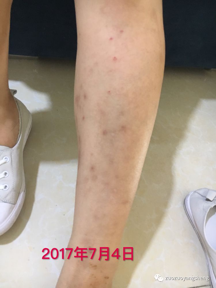 案例分享:原始点调理全身奇痒无比的湿疹案例 案例分享:原始点调理全身奇痒无比的湿疹案例