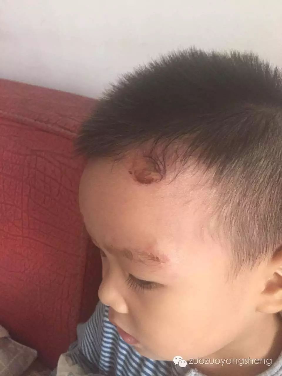 案例分享：温敷的奇迹——原始点调理带状疱疹的案例