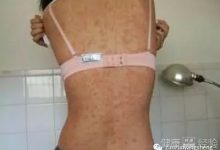 案例分享:原始点调理孕妇全身玫瑰藓的案例-原始点全球同学网